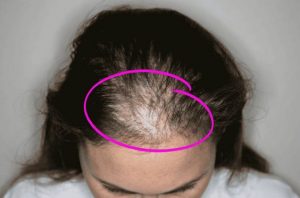 Saç Dökülmesine Ne İyi Gelir Kesin Çözümlü - Tarz Kadın