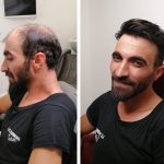 Protez saç bakımı