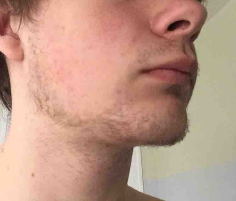 sakal çıkmamasının nedenleri