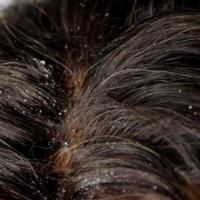 Saçtaki kepek nasıl giderilir