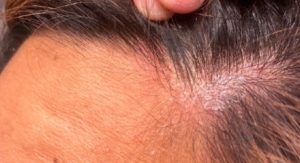 Boyadan Sonra Saç Diplerinde Yara Ve Kabuklanma - Tarz Kadın