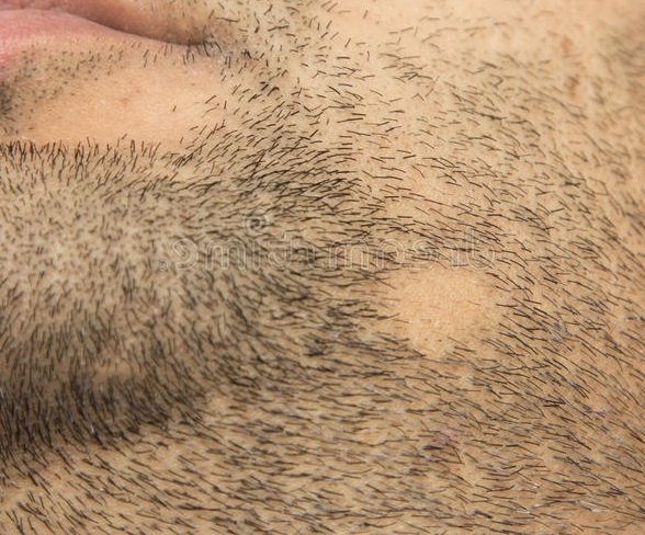 Sakal-dokulmesinde-dogal-tedavi-var-mi