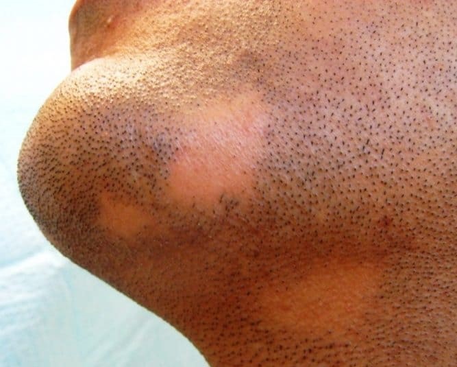 Sakal-kiran-tedavisi-sonrasi-dokulen-sakallar-cikar-mi