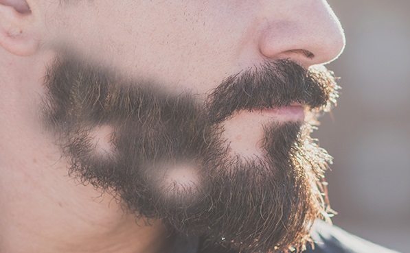 Sakal-kiran-tedavisi-var-mi