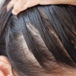 saç derisi neden acır