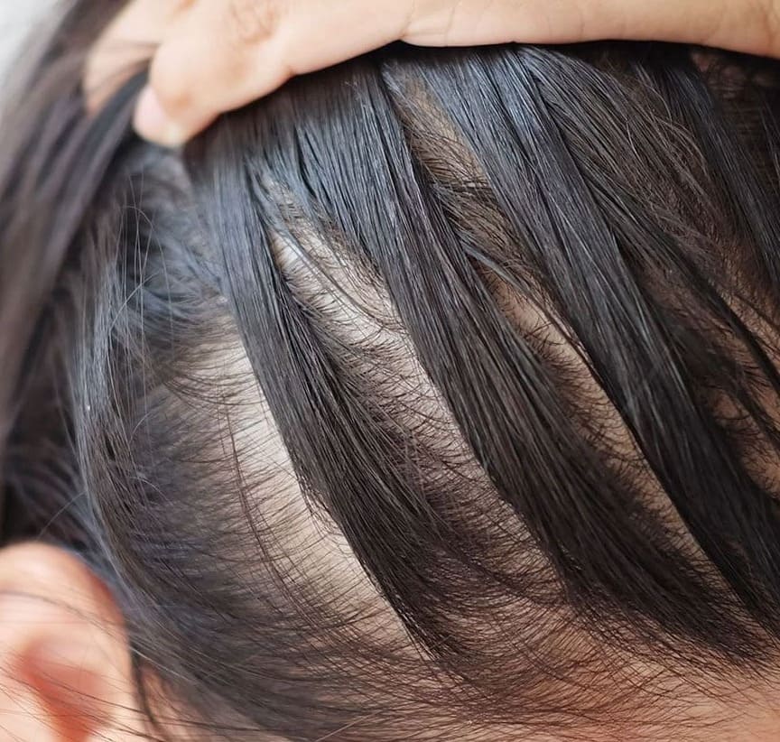 saç derisi neden acır