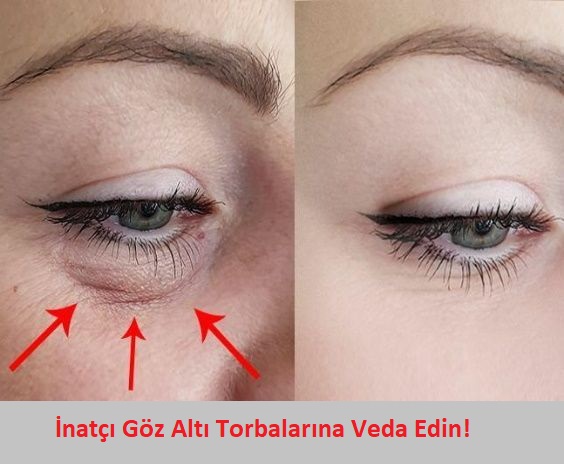 Göz Altı Şişliği Neden Olur, Ne İyi Gelir? Kesin Çözümler